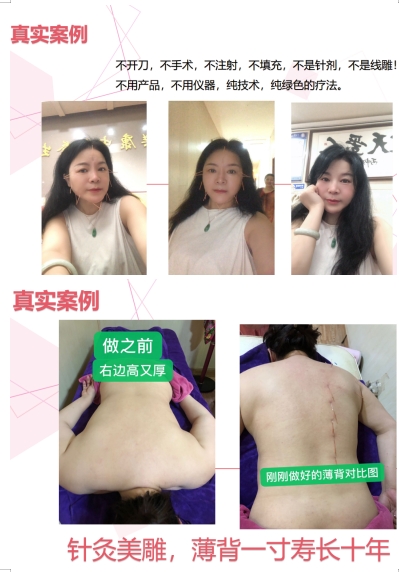 【“五一”劳动节特别报道】 中医针灸浅筋膜非遗传承人——邓国珍 一针丰胸，一针治疗人体九成以上的疾病！
