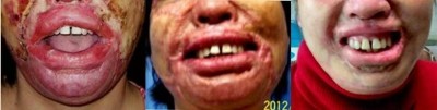 回归本源，让疤痕收回本该易防易治的本来形象！  去除疤痕——几千年做错了这一件事  排毒养疤——让疤痕还回了本容易康复的事情